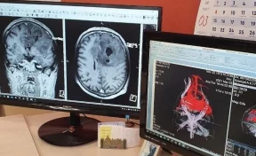 В Кемерове врачи удалили пациенту опухоль головного мозга размером с гранат