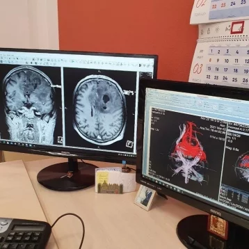 Фото: В Кемерове врачи удалили пациенту опухоль головного мозга размером с гранат 1
