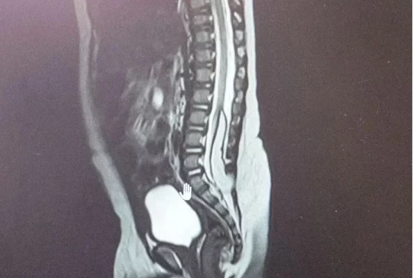 В Кемерове нейрохирурги спасли двух новорождённых с редкой аномалией спинного мозга