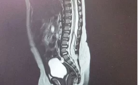 В Кемерове нейрохирурги спасли двух новорождённых с редкой аномалией спинного мозга