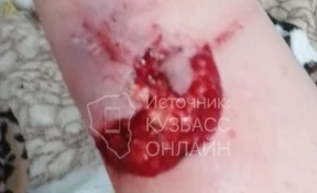 Бездомная собака напала на ребёнка и разорвала его ногу до мяса в Кузбассе