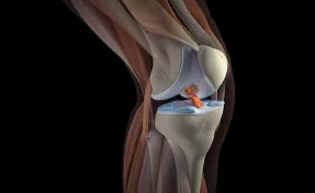 Китайские медики впервые пересадили пациенту отпечатанное на 3D-принтере колено
