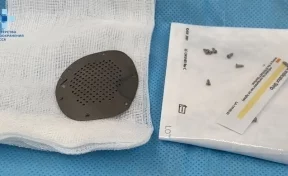 Кемеровские хирурги установили в черепе ребёнка пластину, напечатанную на 3D-принтере