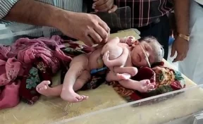 В Индии родилась девочка с четырьмя ногами и тремя руками 