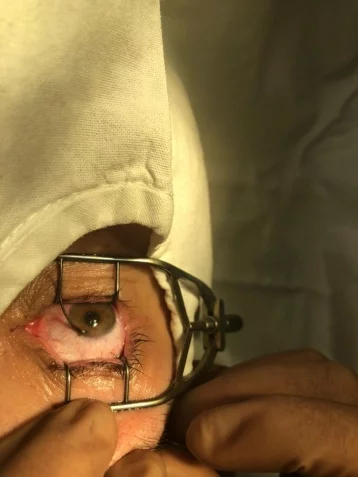 Фото: Кемеровские врачи смогли сохранить мужчине глаз, в который попала проволока 1