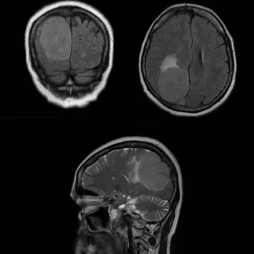 Фото: В Кемерове хирурги спасли женщину с крупной опухолью головного мозга 1