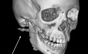 В Приморье школьник получил пулю в лицо во время игры с другом