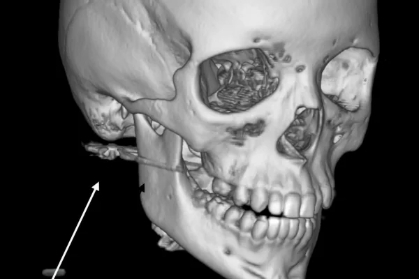 В Приморье школьник получил пулю в лицо во время игры с другом