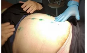 В Кемерове хирурги удалили грыжу без разрезов