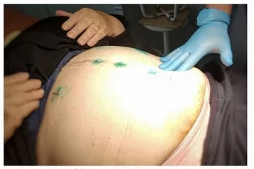 Фото: В Кемерове хирурги удалили грыжу без разрезов 1