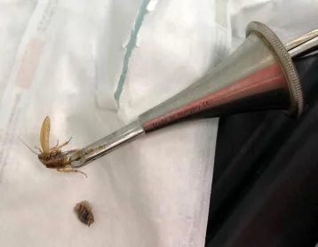 Фото: Из уха достали таракана: в больнице рассказали подробности лечения кемеровчанина 1