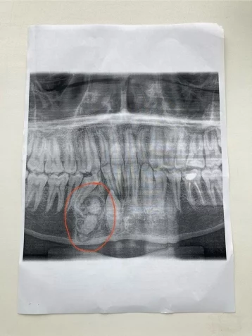 Фото: У ребёнка выросло 30 лишних зубов во Владимирской области 1