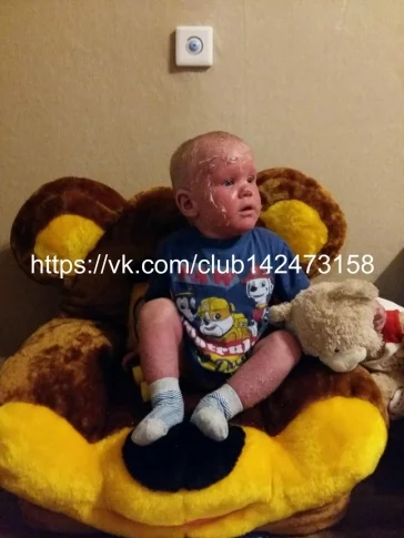 Фото: Кемеровчан просят помочь двухлетнему мальчику с «ошпаренной» кожей  2