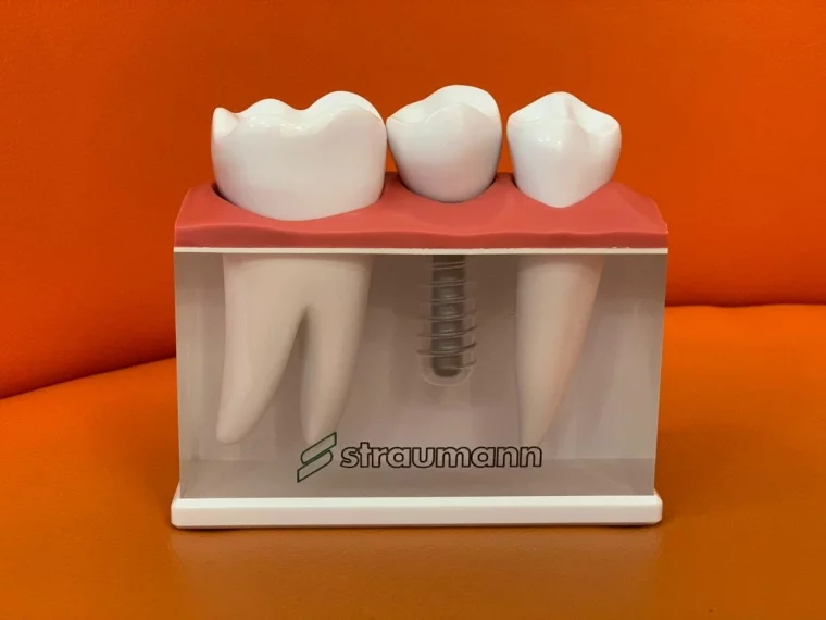Фото: Имплантация зубов, или как сохранить красивую улыбку без боли 4