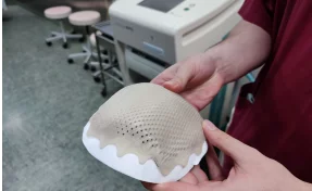 В Кузбассе пациенту с травмой головы напечатали фрагмент черепа на 3D-принтере