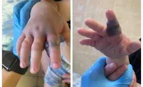 В Кемерове медики спасли годовалого ребёнка, которого укусила гадюка