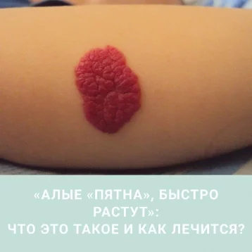 Фото: Кузбасские онкологи рассказали об алых пятнах на коже и об их лечении 1