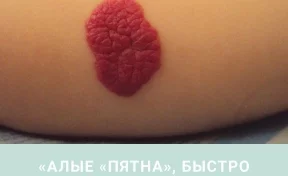 Кузбасские онкологи рассказали об алых пятнах на коже и об их лечении