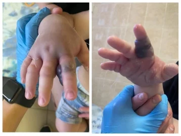 Фото: В Кемерове медики спасли годовалого ребёнка, которого укусила гадюка 1