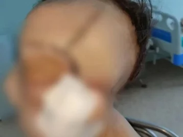 Фото: Кузбасские врачи удалили с лица девушки редкую опухоль весом 5 кг 3