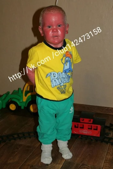 Фото: Кемеровчан просят помочь двухлетнему мальчику с «ошпаренной» кожей  4