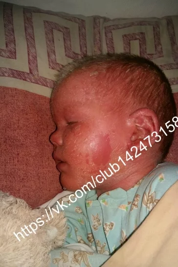 Фото: Кемеровчан просят помочь двухлетнему мальчику с «ошпаренной» кожей  5