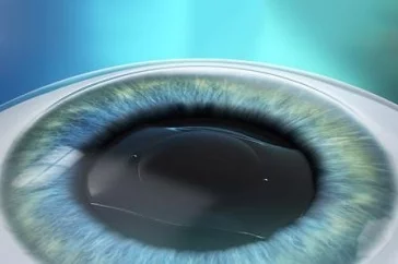 Факичная линза внутри глаза