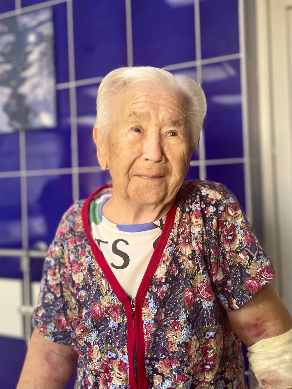 В Кузбассе 90-летняя женщина смогла ходить после перелома шейки бедра