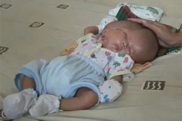 Фото: В Индонезии родился ребёнок с двумя лицами 1