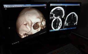 В Барнауле врачи спасли мужчину, который сутки ходил с пулей в голове