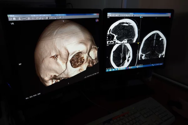 В Барнауле врачи спасли мужчину, который сутки ходил с пулей в голове