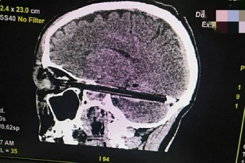 Фото: Названа причина попадания шариковой ручки через глаз в мозг пациента из СИЗО 1