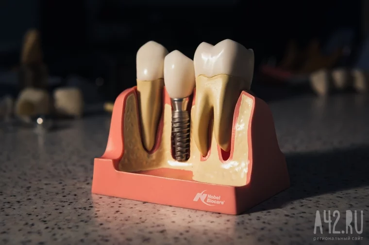 Фото: Восстановить утраченный зуб без мучений: стоматолог «Улыбки» рассказал об имплантации 10