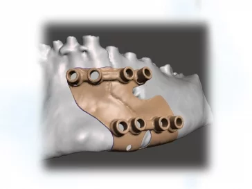 Фото: Молодые учёные Кемеровского медицинского университета усовершенствовали хирургическое лечение переломов нижней челюсти 3