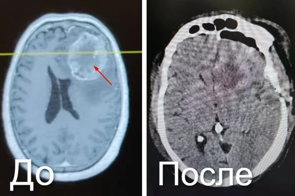 В Новокузнецке нейрохирурги спасли пациента с 7-сантиметровой опухолью мозга