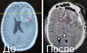В Новокузнецке нейрохирурги спасли пациента с 7-сантиметровой опухолью мозга
