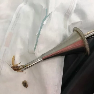 Фото: Жаловался на боли: кемеровчанин пришёл в больницу с насекомым в ухе 3