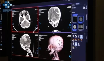 Фото: Кемеровские врачи спасли 6-месячного ребёнка с огромной гематомой на голове 1