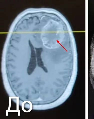 В Новокузнецке нейрохирурги спасли пациента с 7-сантиметровой опухолью мозга