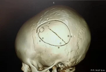 Фото: В Кемерове врачи спасли 5-летнего мальчика, упавшего с эскалатора 1
