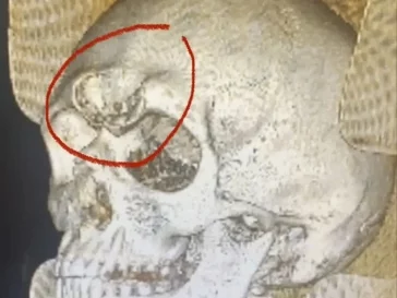 Фото: Кузбасские врачи провели уникальную операцию по восстановлению костей черепа 2