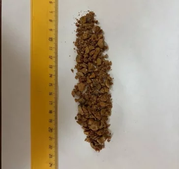 Фото: Ювелирная работа: кузбасские врачи сохранили почку пациентке с крупным коралловидным камнем  1