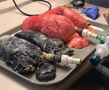 Фото: Медсестра из США опубликовала шокирующее видео с лёгкими здорового человека и курильщика 1