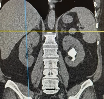 Фото: Ювелирная работа: кузбасские врачи сохранили почку пациентке с крупным коралловидным камнем  2