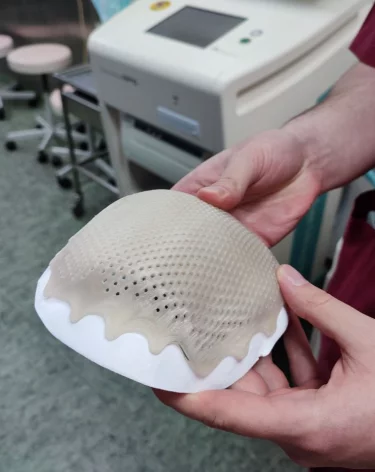 В Кузбассе пациенту с травмой головы изготовили фрагмент черепа на 3D-принтере