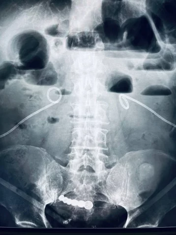 Фото: В Кемерове врачи извлекли их желудка пациента вставную челюсть, которая пробыла там 6 лет 1