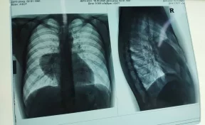 В Кемерове 30-летнему пациенту удалили из лёгкого редкую опухоль 