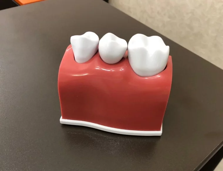 Фото: Имплантация зубов, или как сохранить красивую улыбку без боли 1