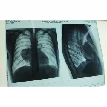 Фото: В Кемерове 30-летнему пациенту удалили из лёгкого редкую опухоль  1