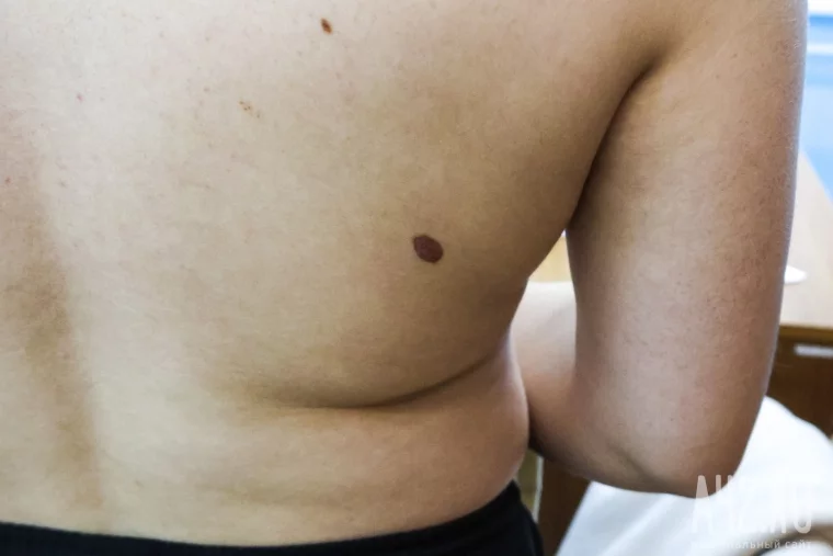 Фото: То ли кератоз, то ли меланома: как я показывал родинки в онкодиспансере в день открытых дверей 11